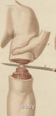 Original CIVIL War Large Medical Surgeons Knife Used For Amputation